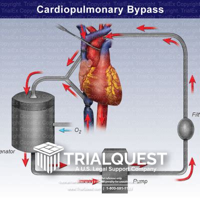 centrifugal pump cardiopulmonary bypass|cardiopulmonary bypass procedure steps.